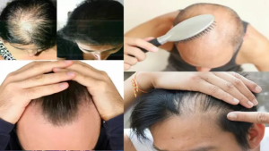 मोटोपन घटाउन यी गल्ती त गर्नुभएको छैन ? कपालको होला नास