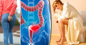 पायल्स, फिसर र फिस्टुला रोग लाग्नुमा खानपानको भूमिका कति ?